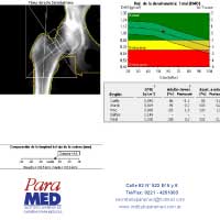 Desintometría Mineral Osea